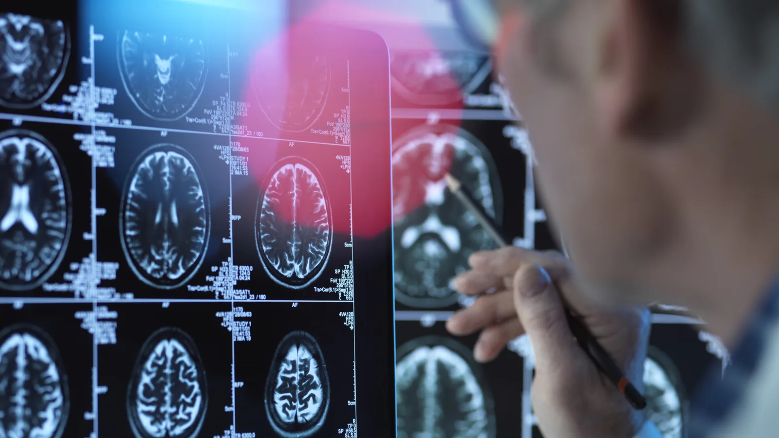 Neurólogo revisando una resonancia magnética de cerebro en Clínica San Javier