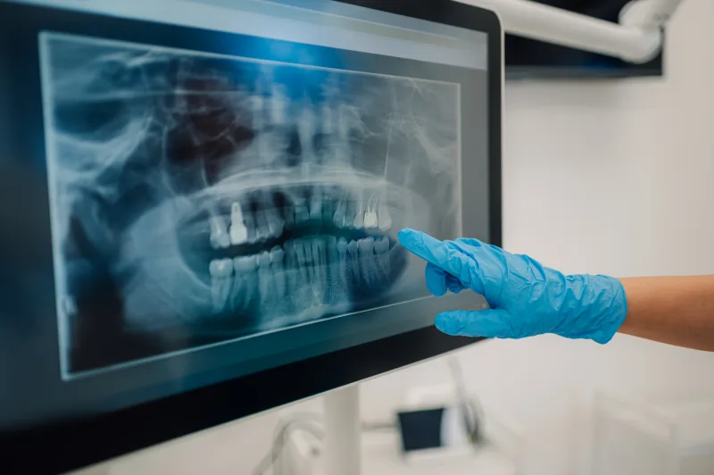 Radiografía Dental en Clínica San Javier